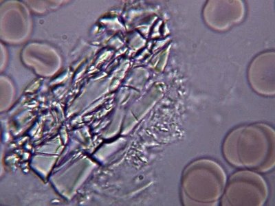 Cristales de ácidos en la sangre Cristales de ácidos en la sangre